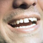 Tara Kachroo | Dental Trauma, Root Canal, Neuropathy
